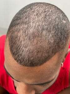 Close-up of a bald-headed person with SMP for a fuller look