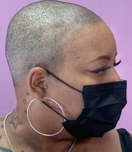 A bald headed woman wearing face mask seeking for SMP treatment