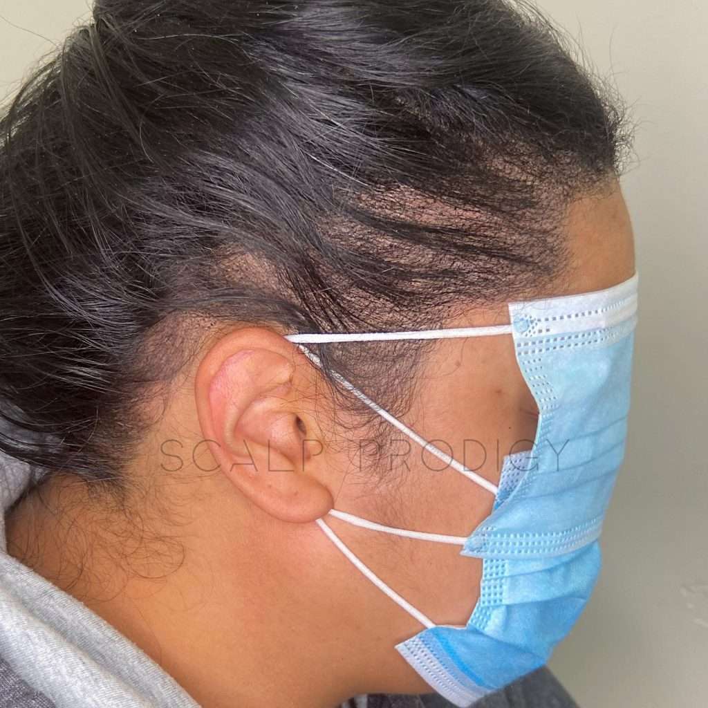 Woman's hairline density treatment results showing a natural and fuller appearance