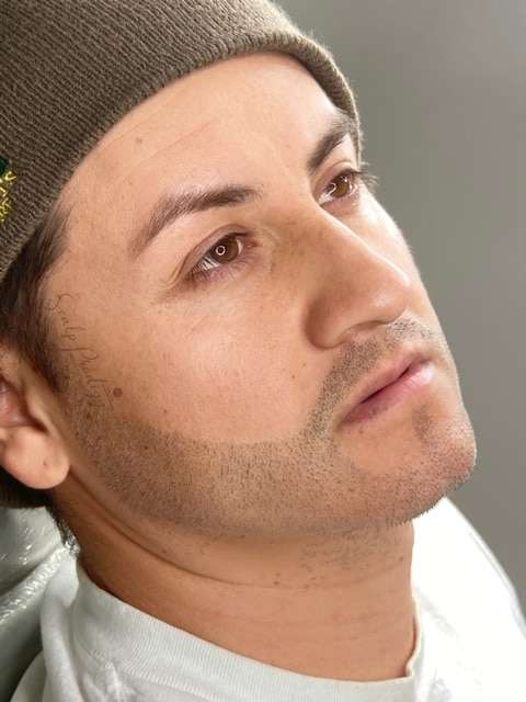 Man showcasing improved hairline density between hair and beard