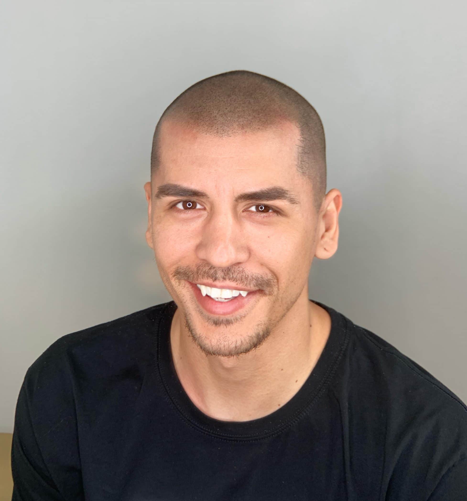 Scalp Micropigmentation treatment with maintaining perfect skin tone