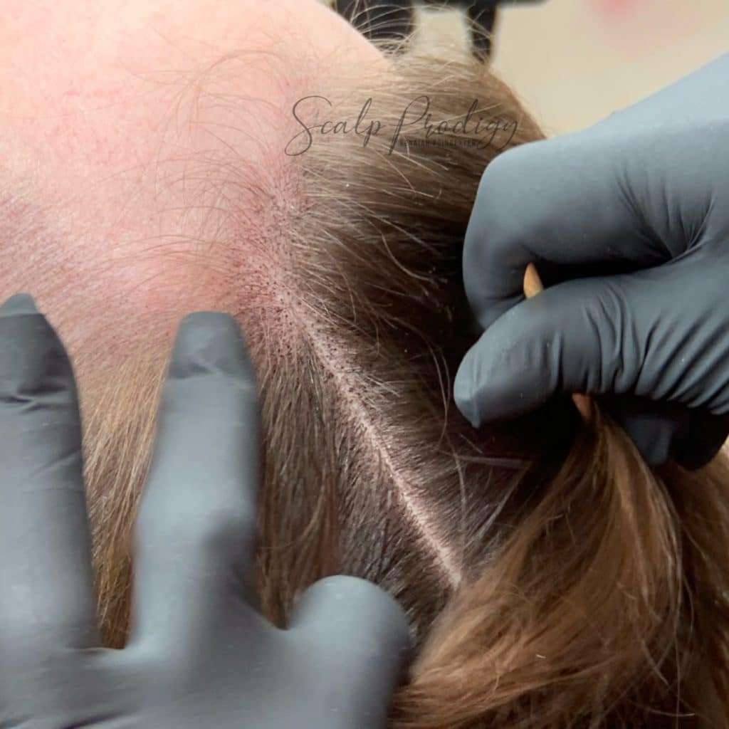 Part line Scalp Micropigmentation of a woman