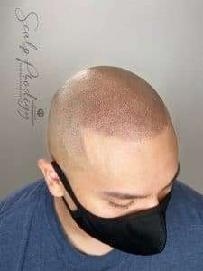 Permanent SMP treatment of bald headed person showcasing his scalp