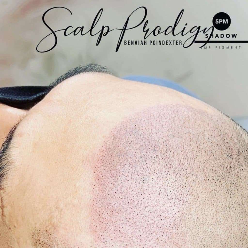 Reconstructive Scalp Micropigmentation