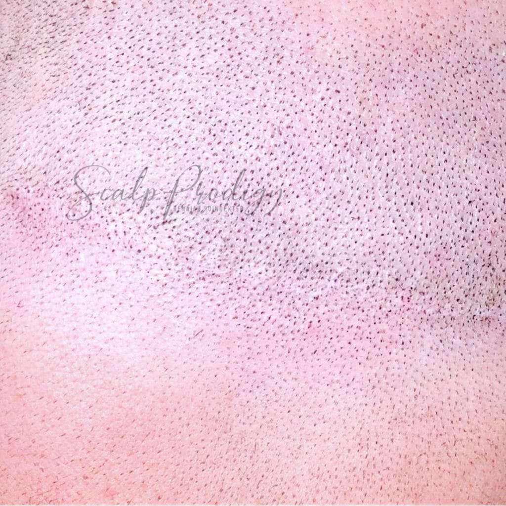 Scar removal on bald head through SMP treatment