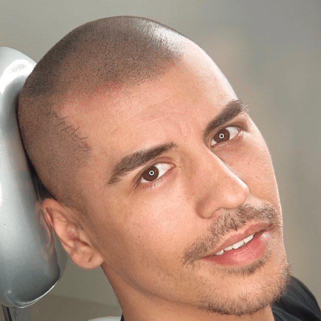 A young boy undergoing the second session of scalp micropigmentation procedure