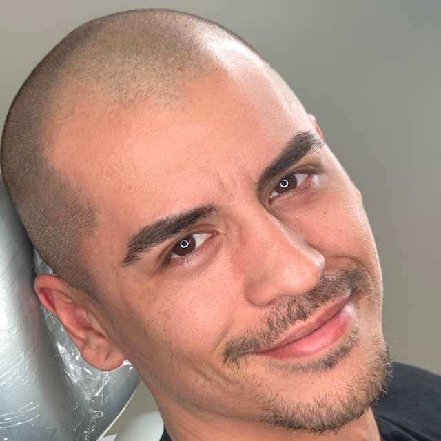 First session of Scalp Micropigmentation: creating front hairline