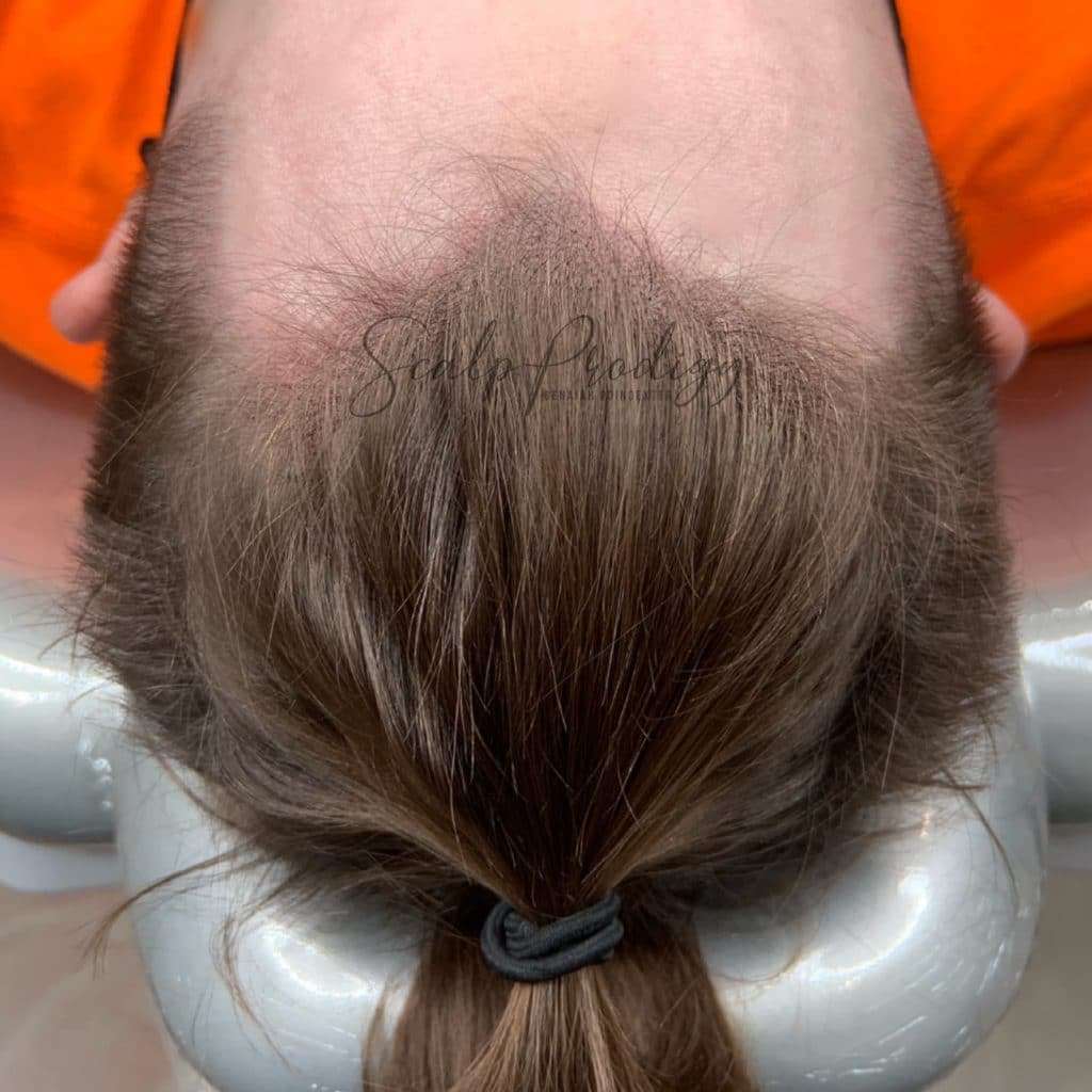 Determining hairline for SMP