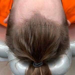 Determining hairline for SMP