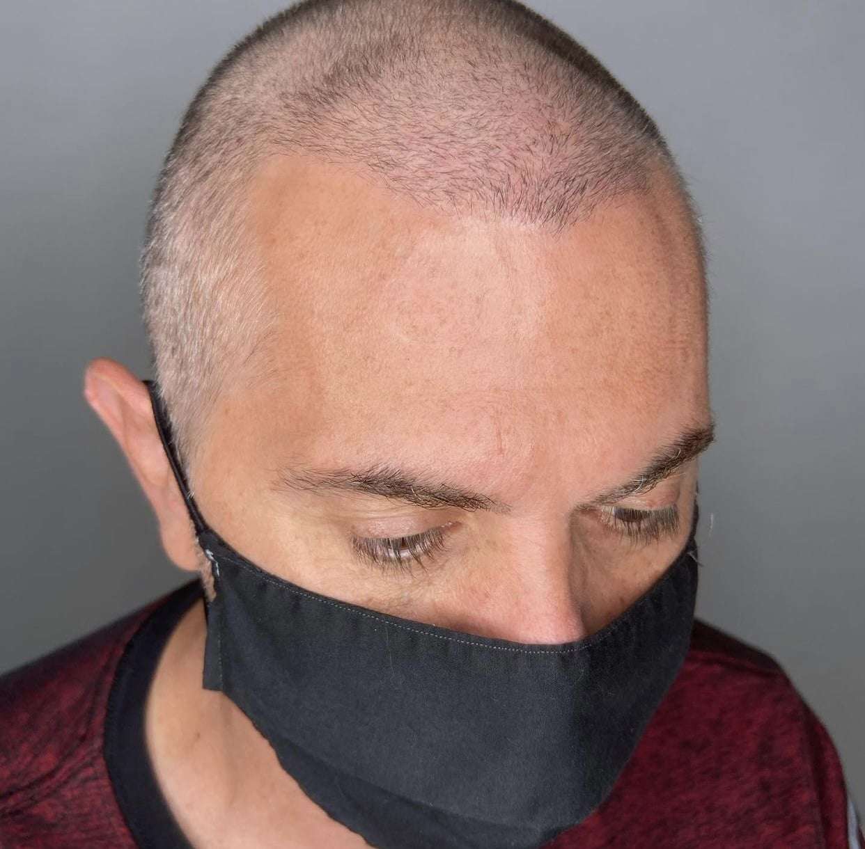 Bald man wearing a face mask, showcasing modern hair loss solution