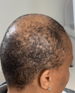 Scalp micropigmentation for balding showcasing natural outcomes