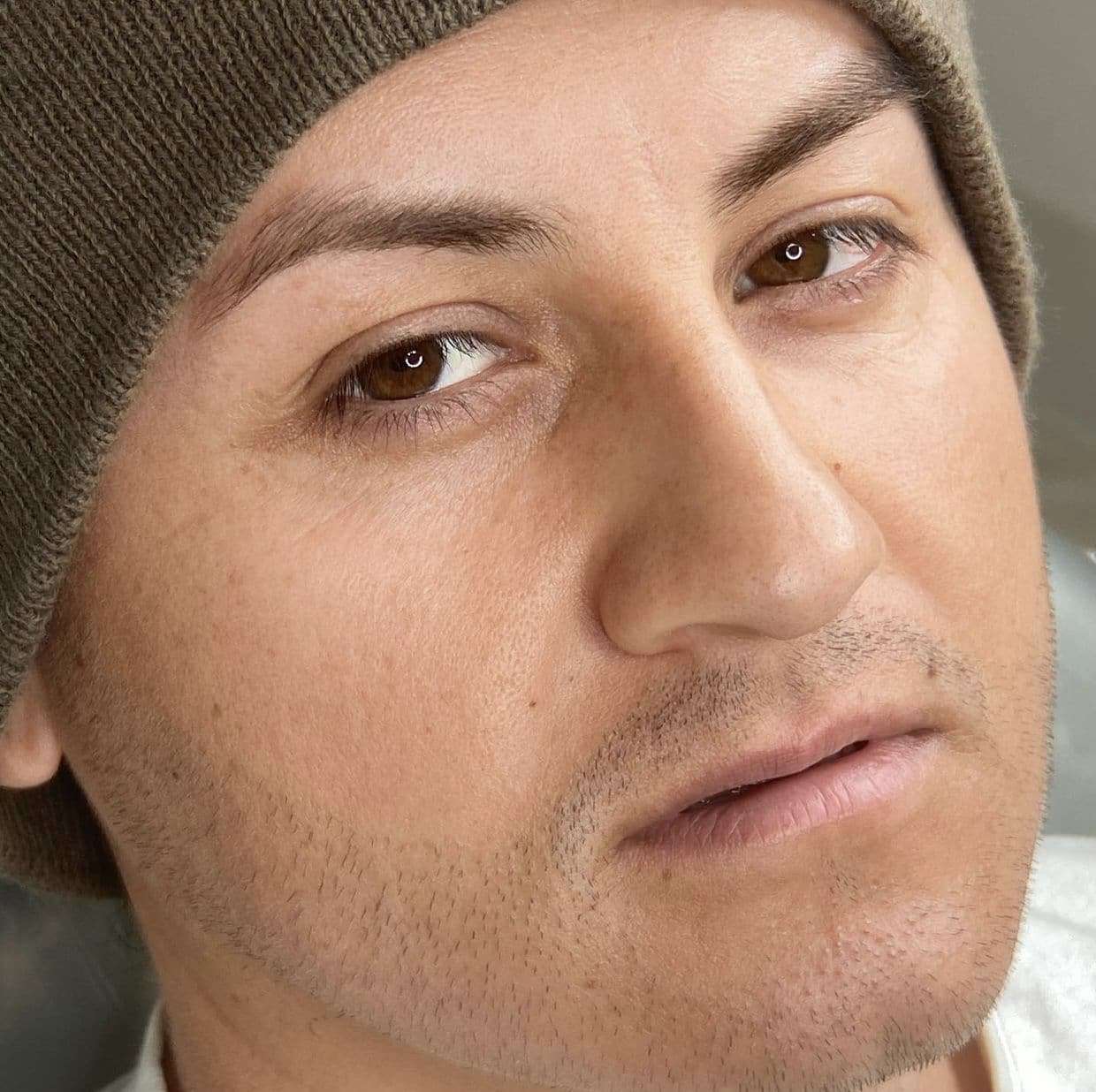 Man highlighting his face, seeking for hairline density treatment