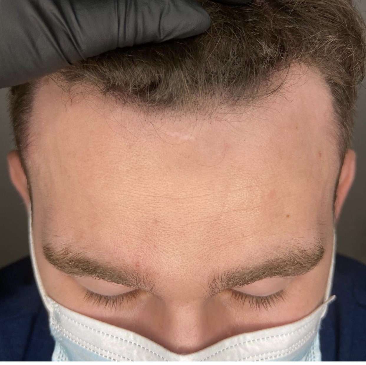 Density treatment showing a well-defined hairline and even scalp coverage