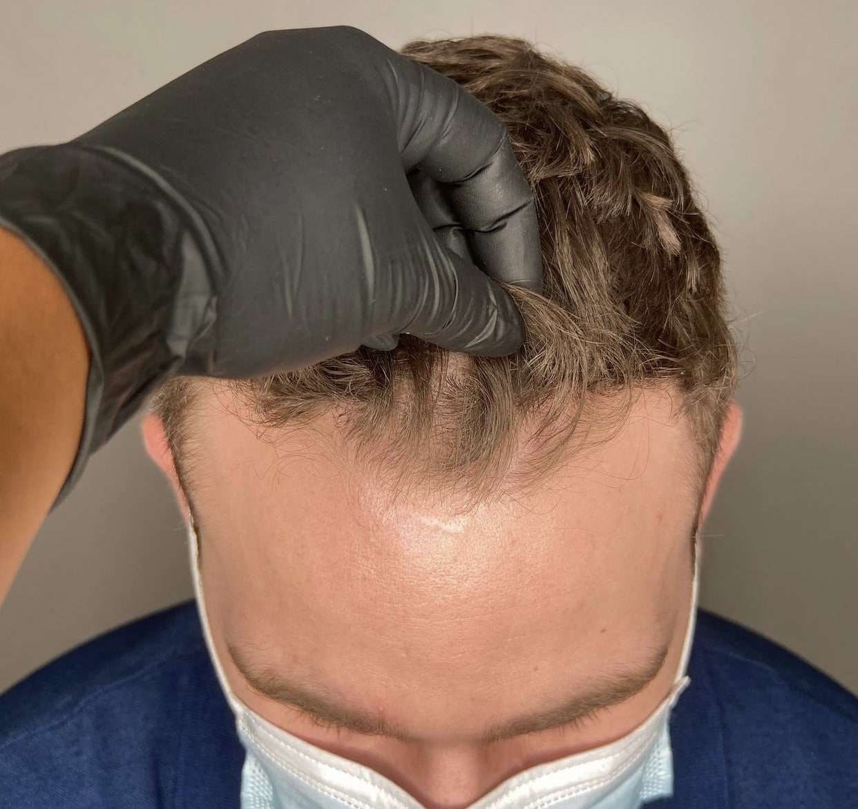 Hairline density treatment results showing a natural and fuller looks