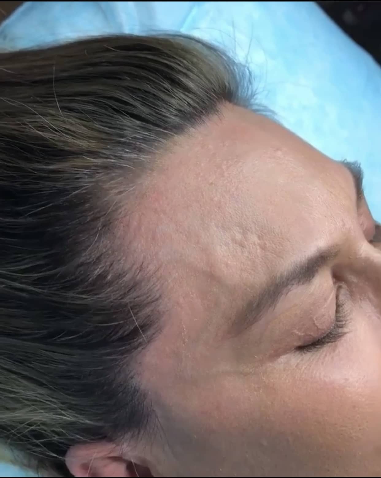 SMP treatment for scar camouflage applying to a middle age woman