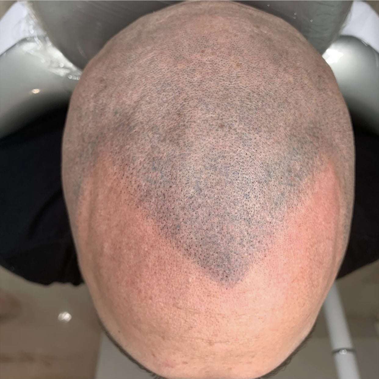 Post result of Scar Camouflage on a bald head