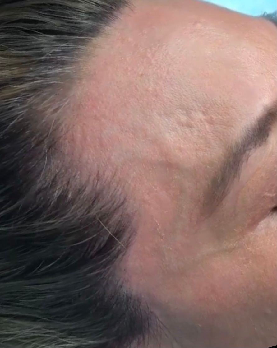 Female Scalp Micropigmentation