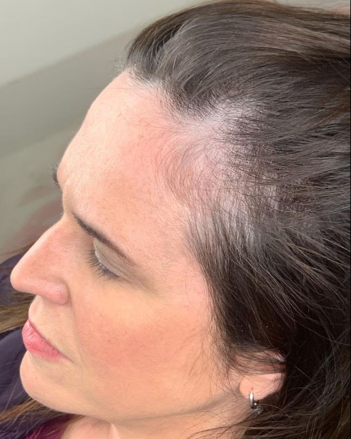 Female Scalp Micropigmentation