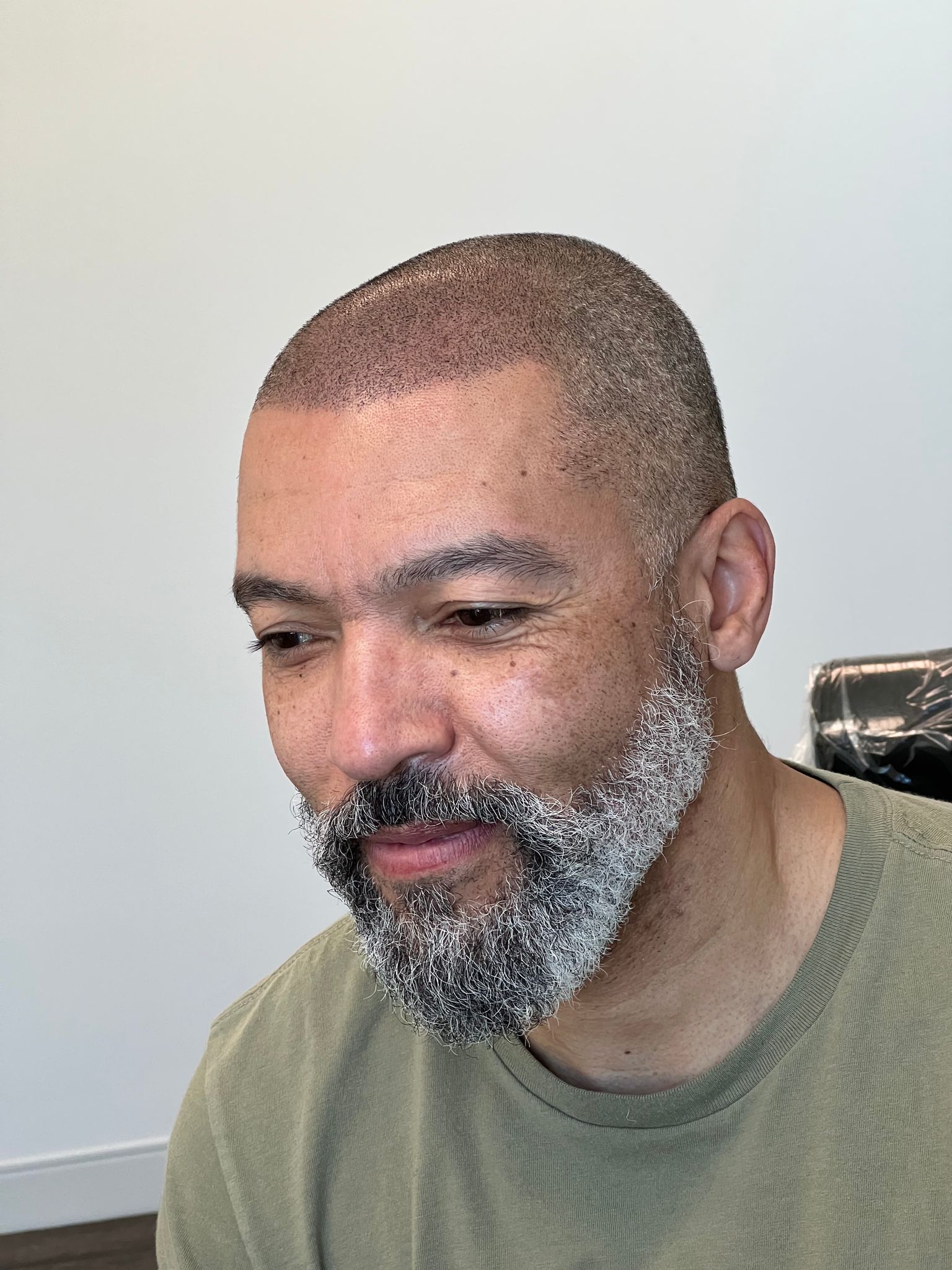 Male Scalp Micropigmentation