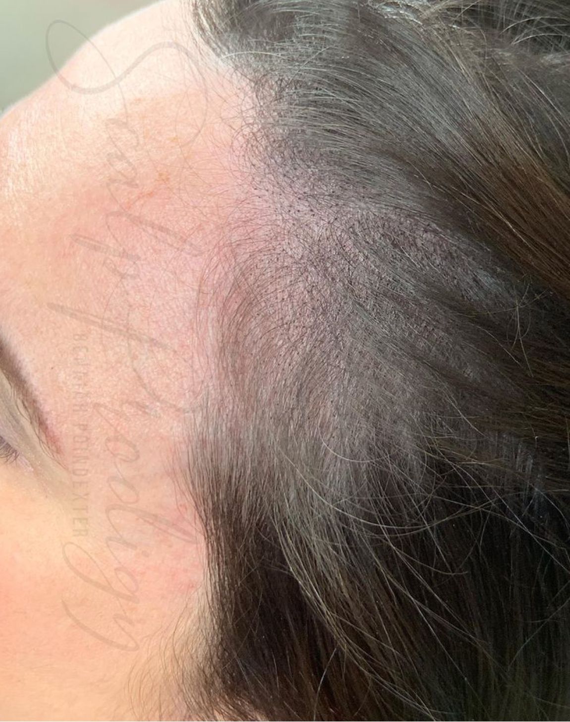 Female Scalp Micropigmentation