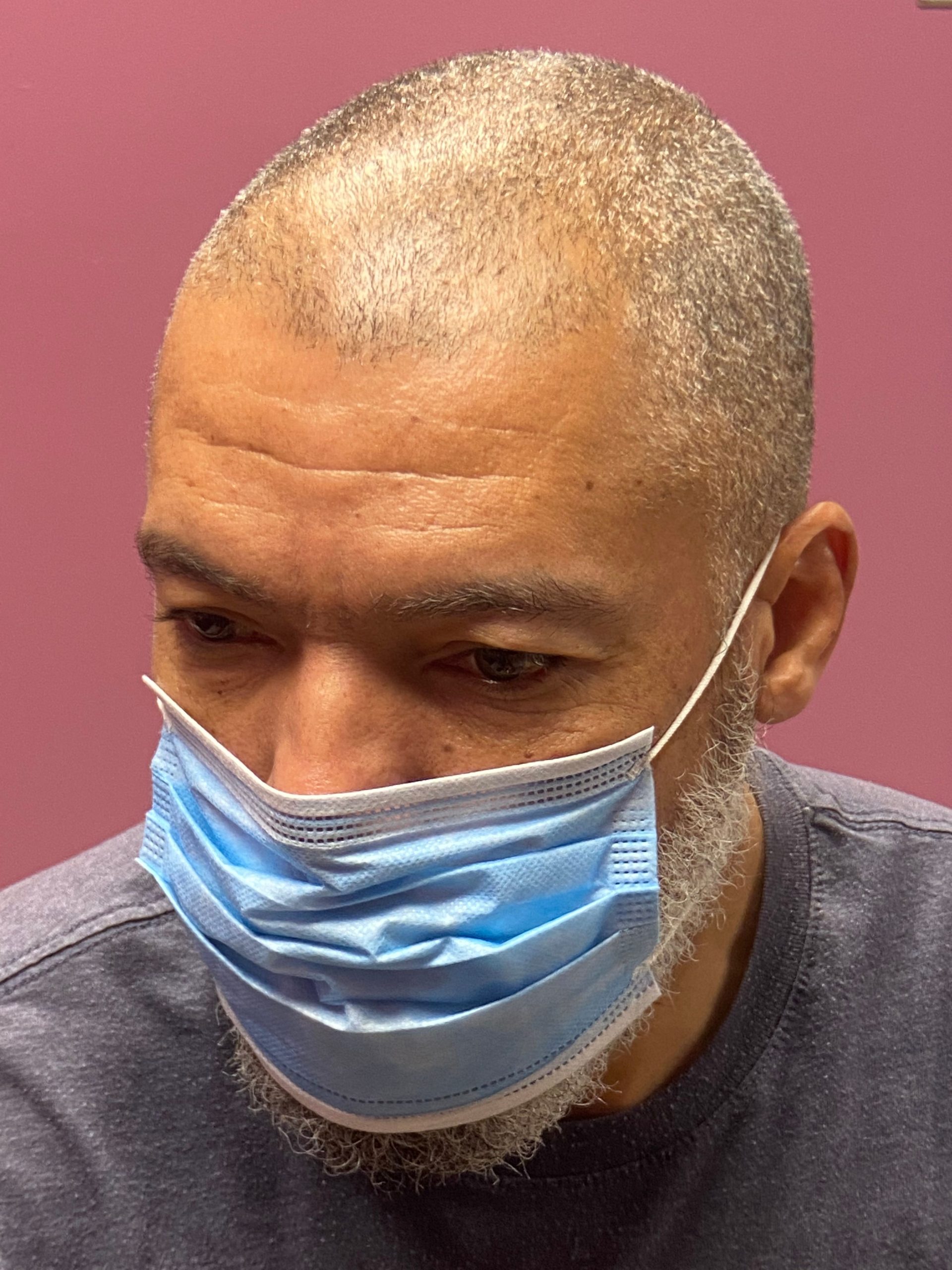 Bald headed person requiring SMP treatment for achieving fuller, more defined look