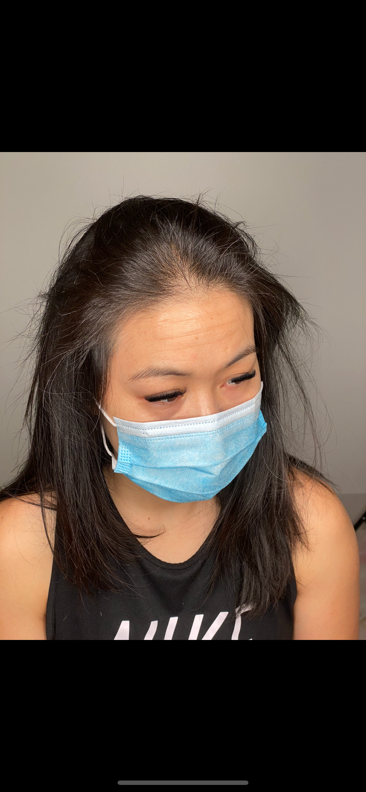 Woman seeking for scalp micropigmentation procedure
