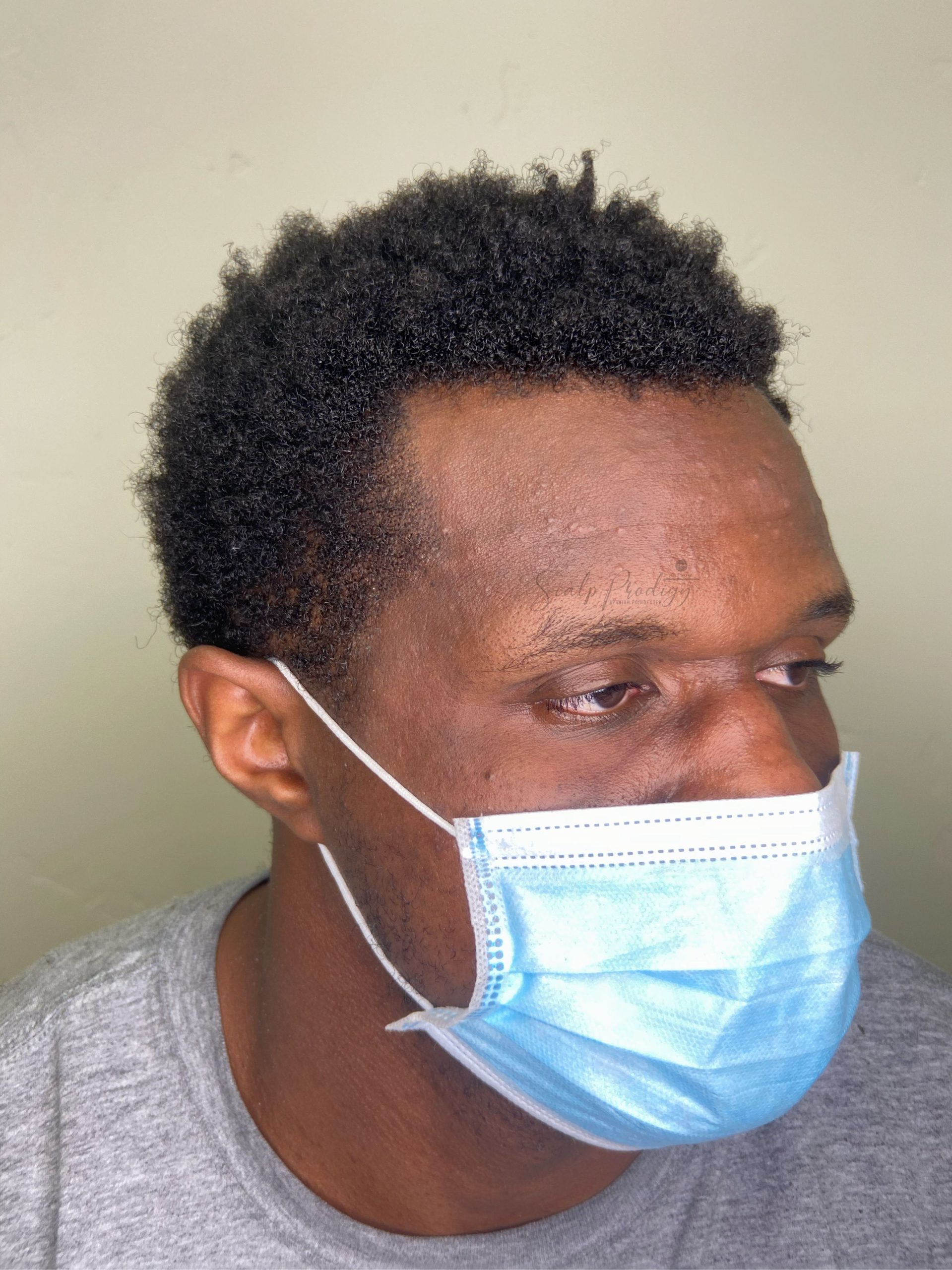 Man facing successful balding treatment, enhancing scalp coverage and density
