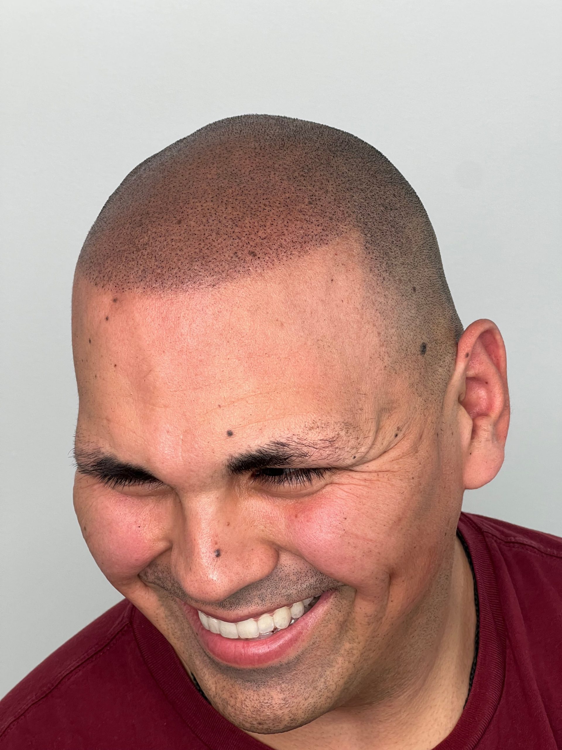 Satisfied balding treatment of client: showcasing appearance of his scalp
