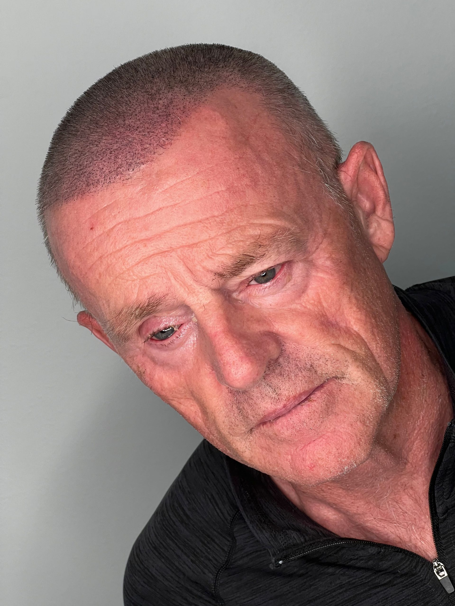 Scalp micropigmentation on a bald-headed person, showcasing a modern hair loss solution