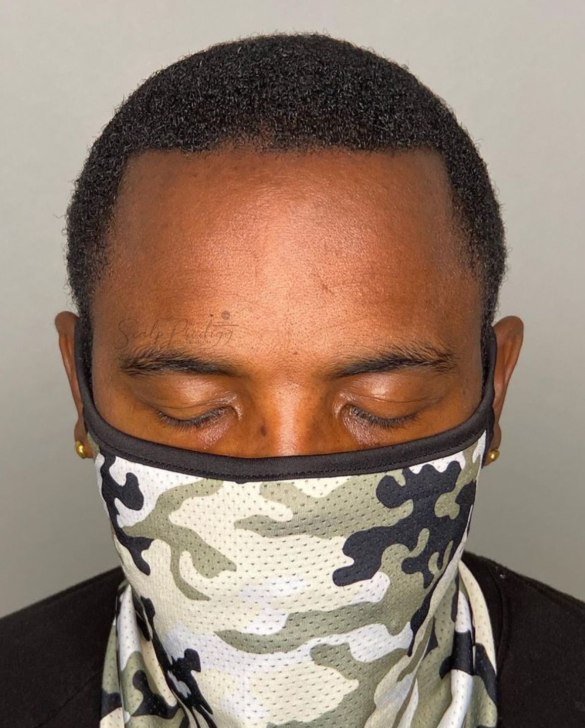 A man showcasing hairline density measure with natural transition