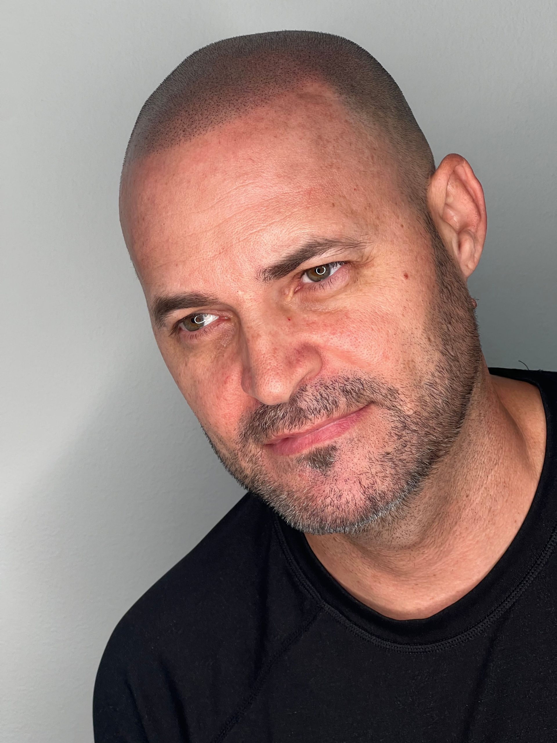 SMP for bald men delivering a confident and natural finish after balding treatment
