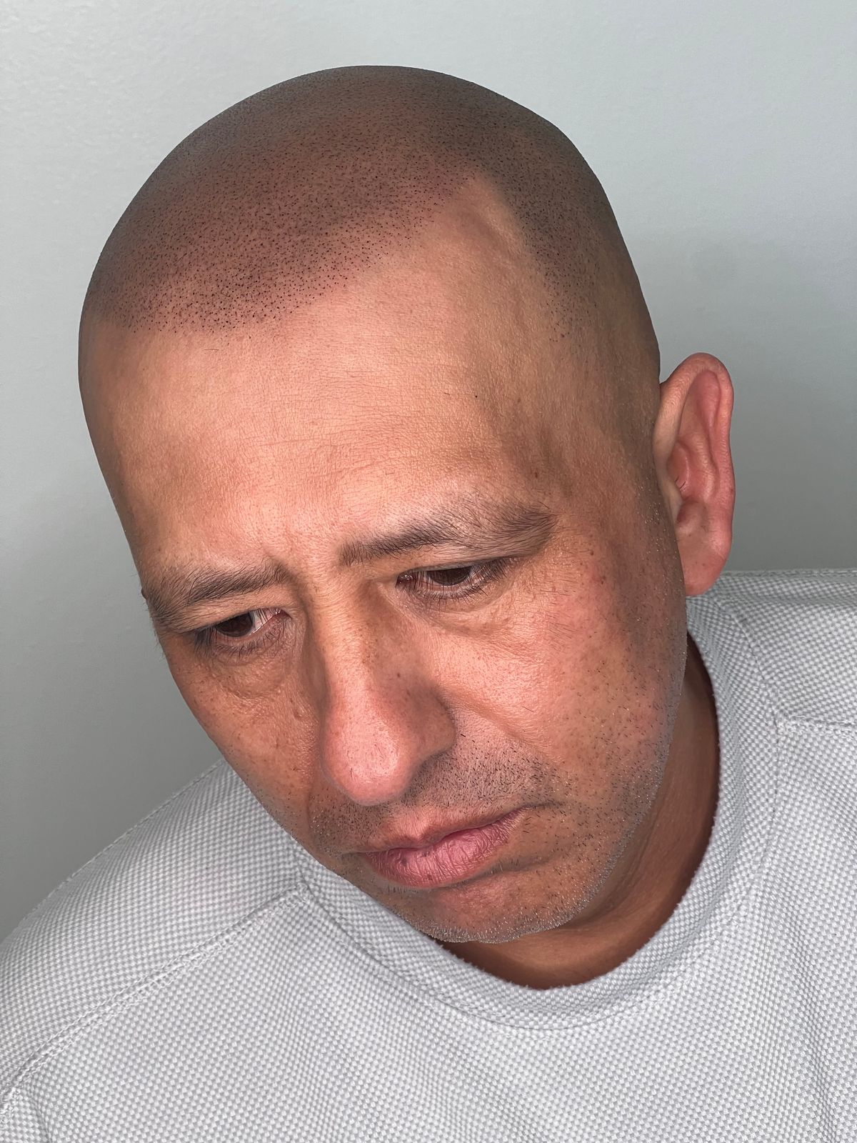 Balding treatment outcomes: A close-up of a hair loss solution