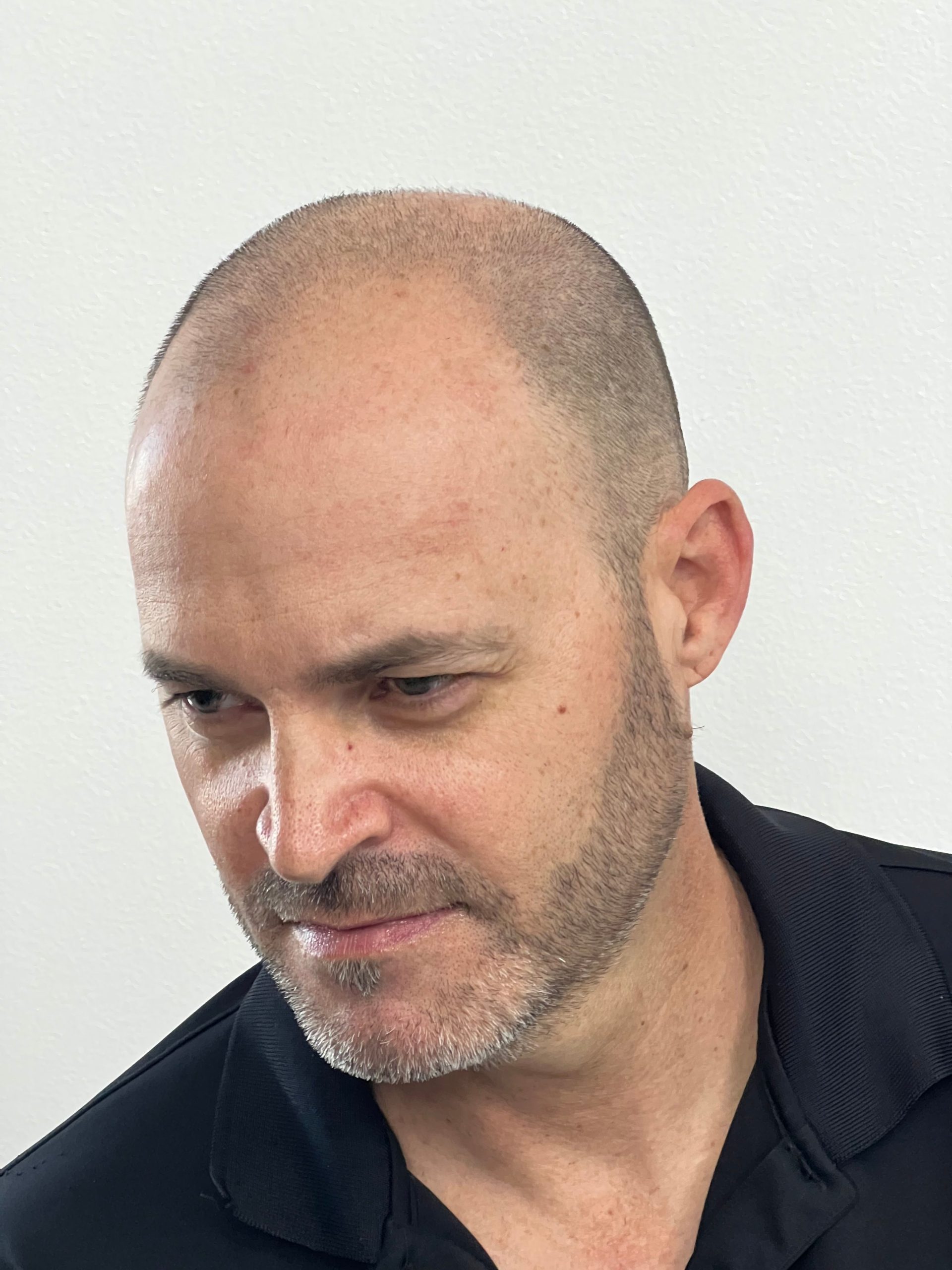 A bald headed man undergoing a cosmetic balding treatment of SMP