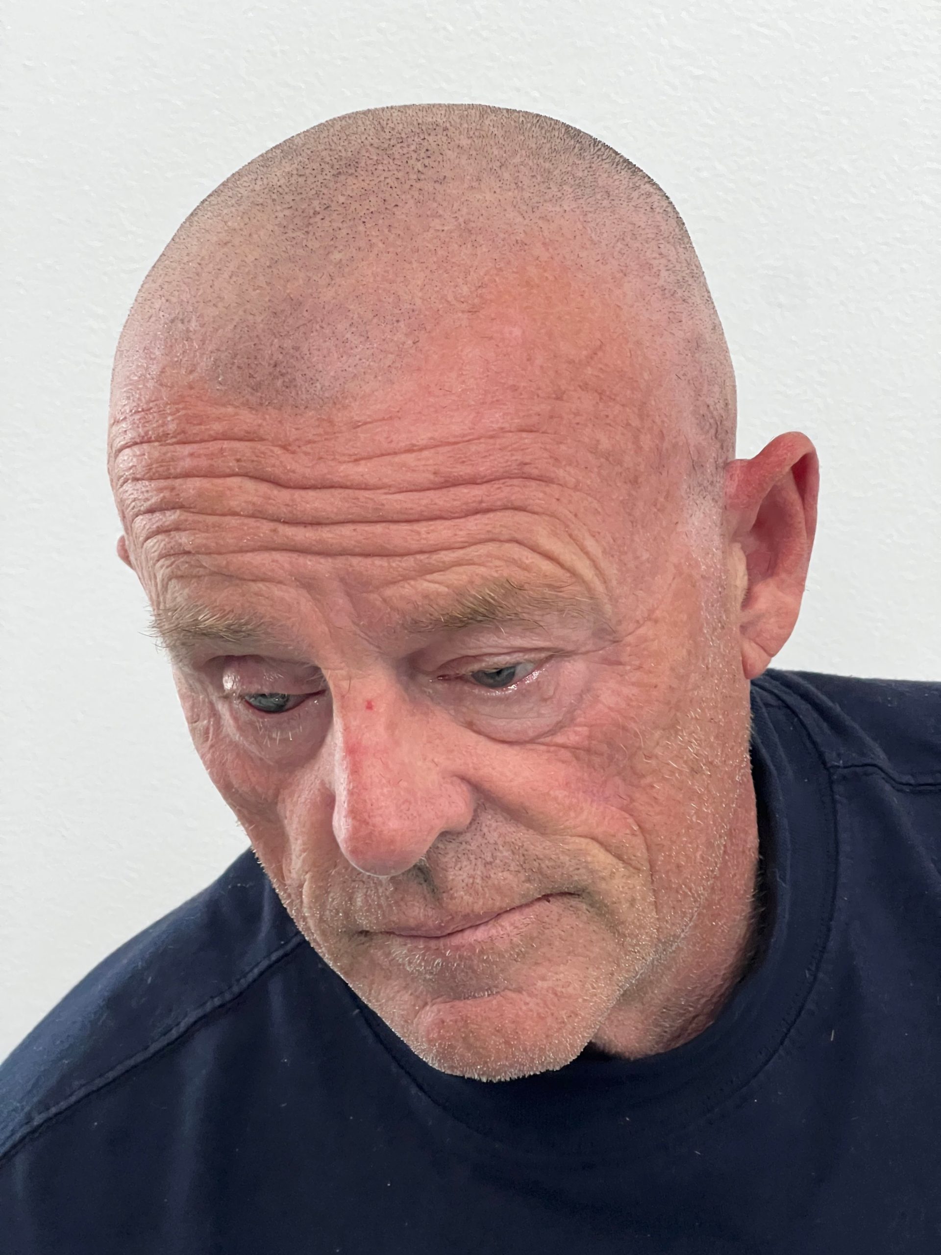 A freshly looked bald senior man seeking for scalp micropigmentation procedure