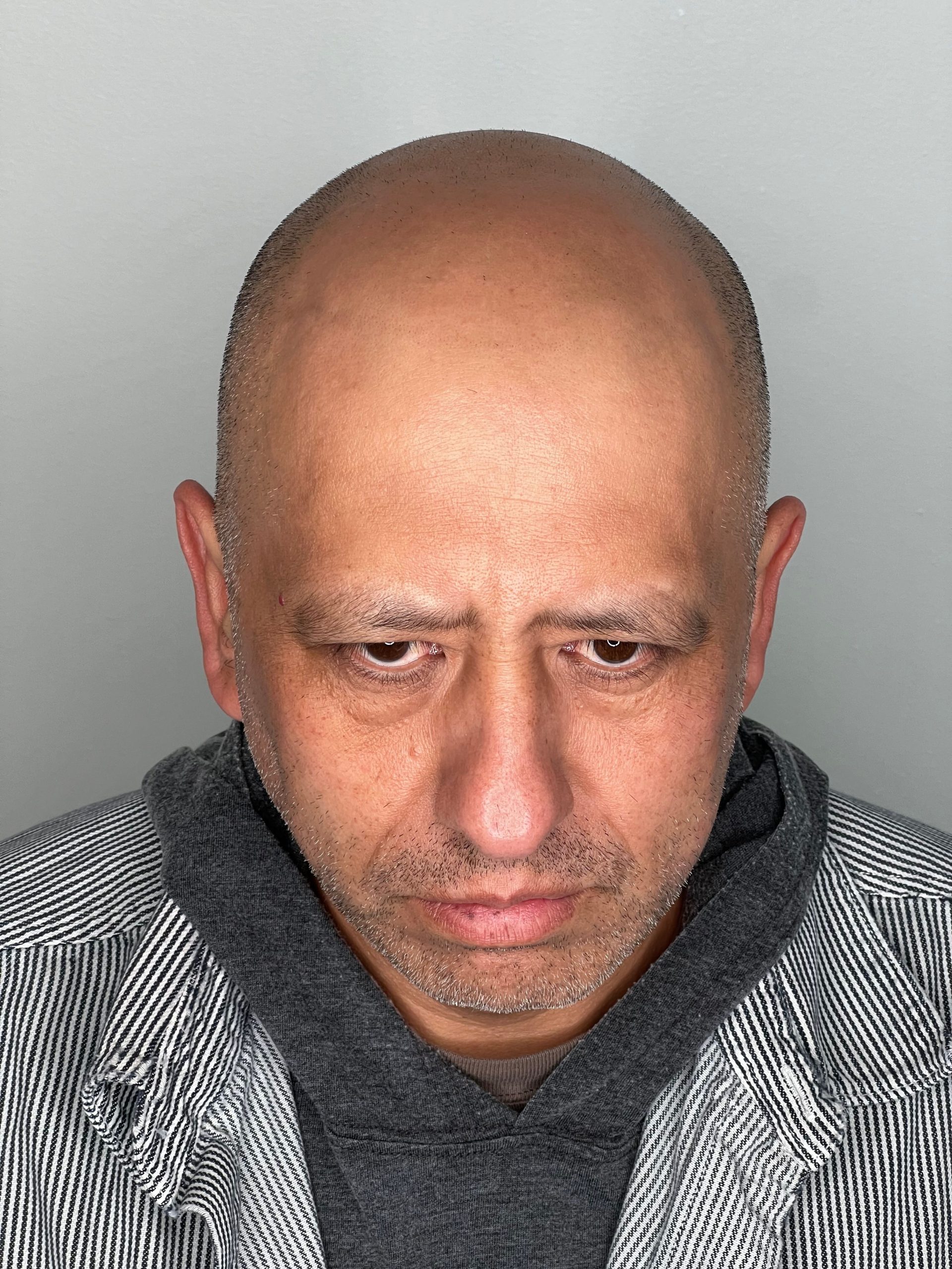 Bald man with freshly treated scalp showcasing unsatisfaction