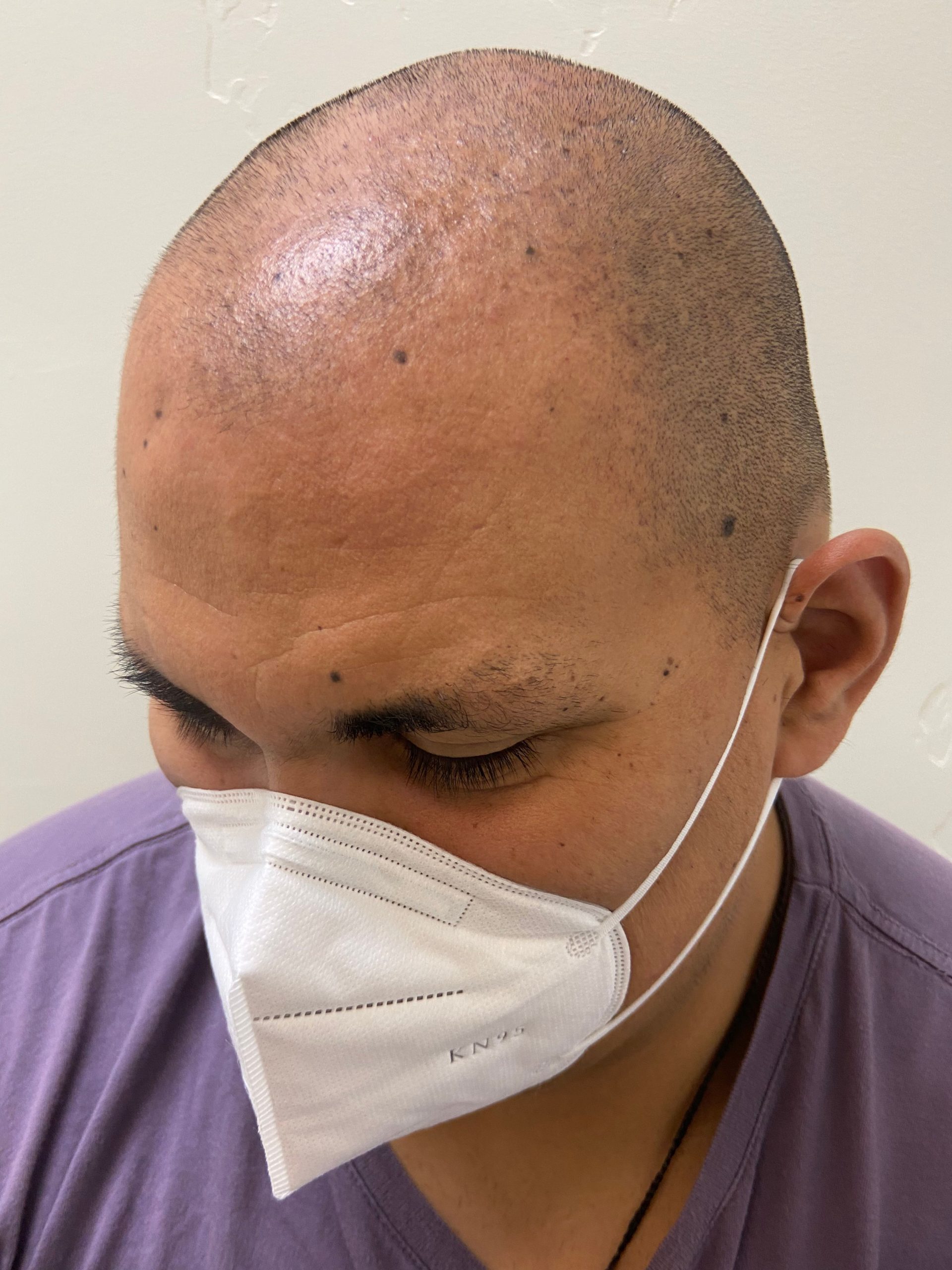 A bald headed person seeking for perfect scalp micropigmentation