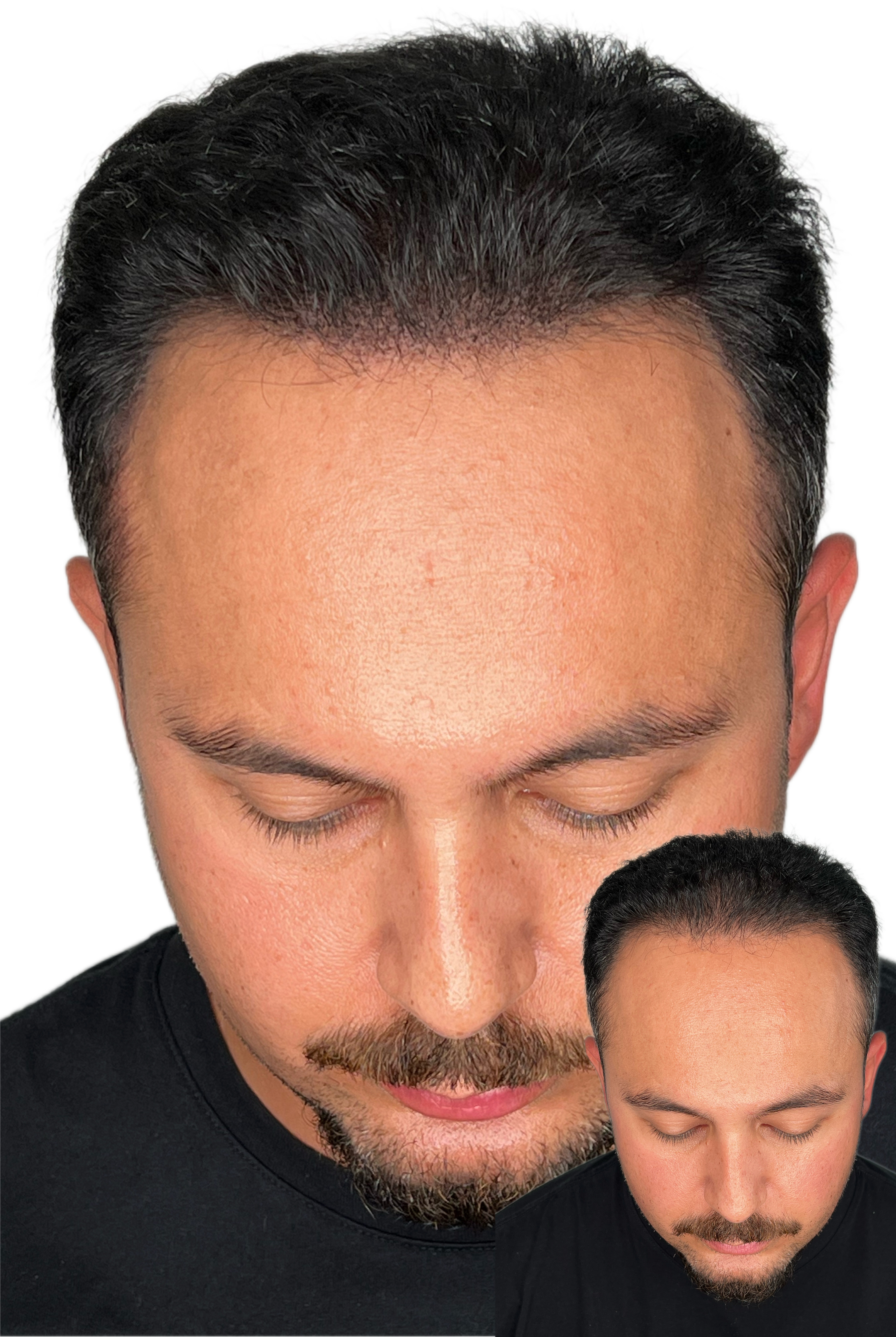 Soft hairline solution of a man